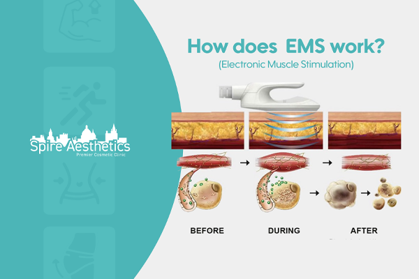 EMS treatment for post pregnancy weight loss treatment Merthyr Tydfil