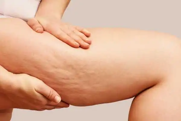 Image of woman showing leg with cellulite Merthyr Tydfil