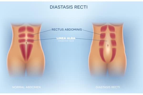 What Non-Surgical Options Are Available for Diastasis Recti Merthyr Tydfil?