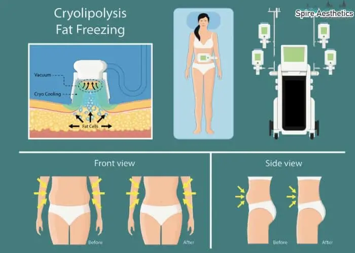 Fat freezing treatment Merthyr Tydfil benefits for competitions to remove stubborn fat deposits.