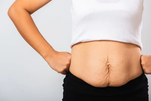 Image of a woman's stomach after weight loss with sagging skin following a gastric band Merthyr Tydfil