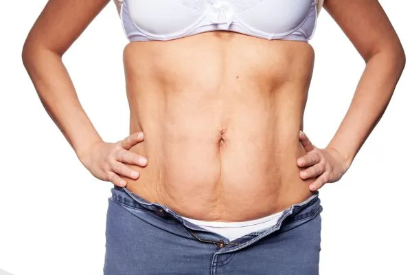 sagging skin on woman's stomach after weight loss injections Merthyr Tydfil