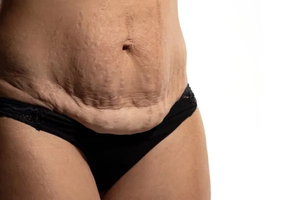 Image of womans stomach after weight loss injections Merthyr Tydfil showing saggy skin