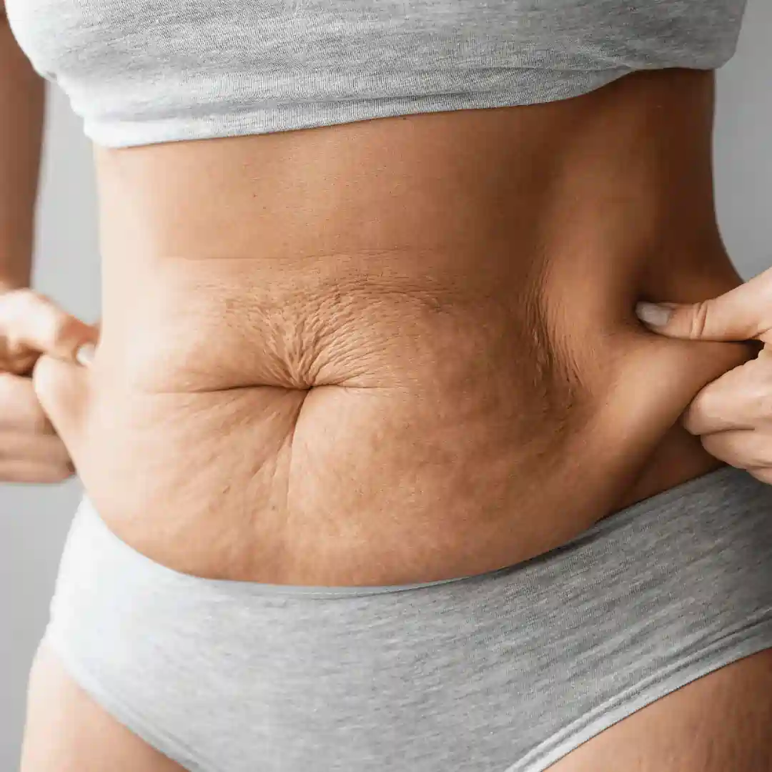Is It Normal to Have Loose Skin After Pregnancy Merthyr Tydfil?